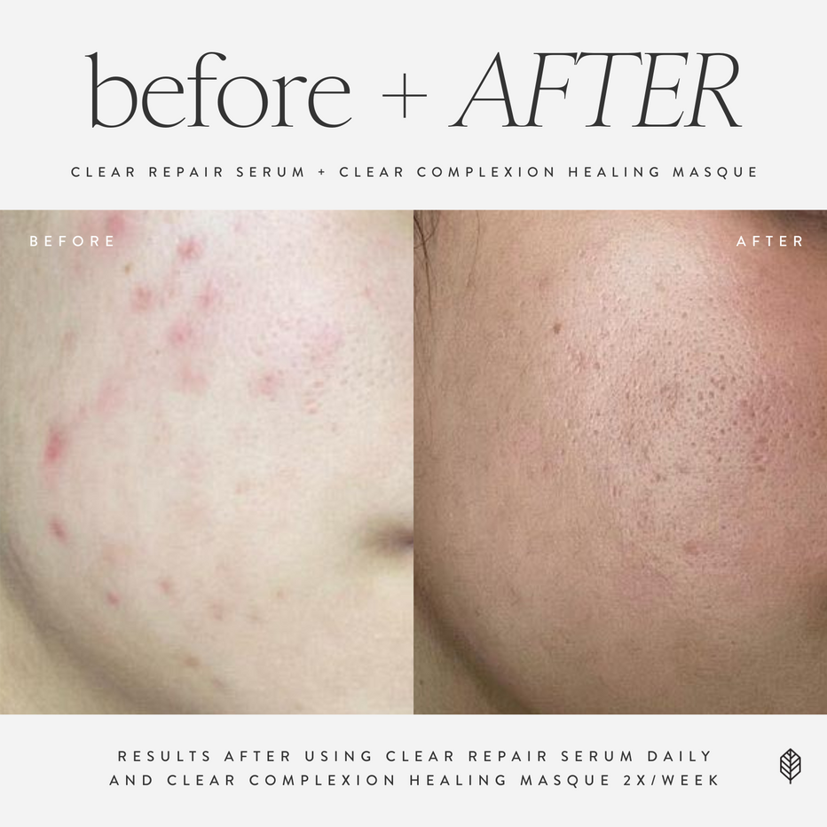 Before and after comparison of skin treatment with text indicating product usage. Clear Repair Serum
